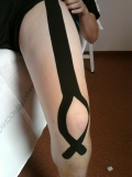 Kineziotaping